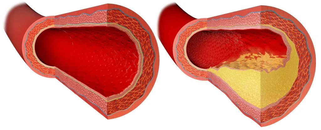 Imagem comparativa de uma arteria limpa e outra com placas de gordura demonstrando alto indice de colesterol no sangue