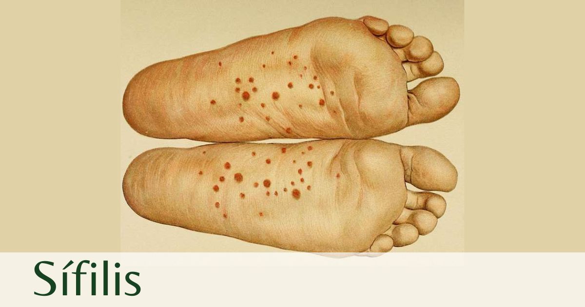 Sifilis